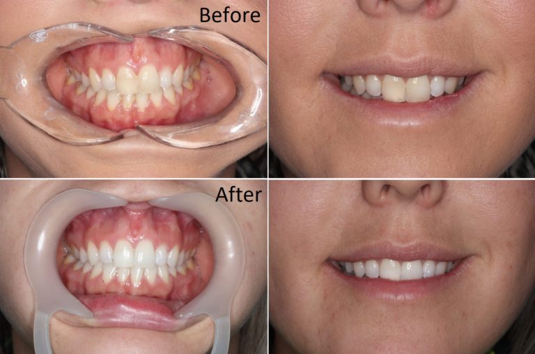 teeth whitening dentist or home kit